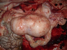 Glanglion msentérique (intestin)